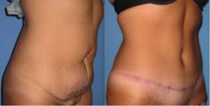 remboursement abdominoplastie