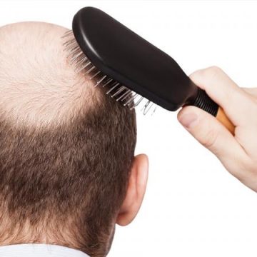 عمليَة زرع الشَعر للرَجال: تمتّعوا بمظهر جذّاب وشعر كثيف