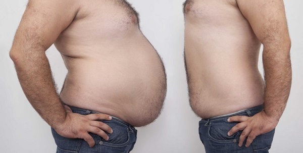 بعد عمليّة شفط الدهون: هل يمكن استرجاع الوزن الزائد؟
