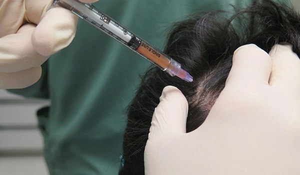حقن البلازما الغنيّة بالصفائح الدمويّة: تقنية حديثة وناجعة ضدّ تساقط الشعر