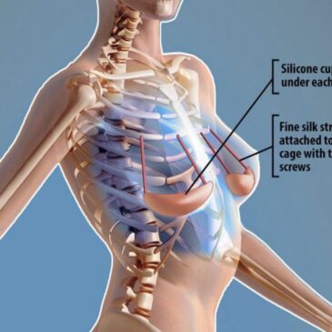 Le soutien-gorge interne : nouvelle invention en chirurgie esthétique