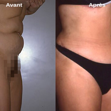 Liposuccion ou lifting du ventre : Quelle intervention choisir ?