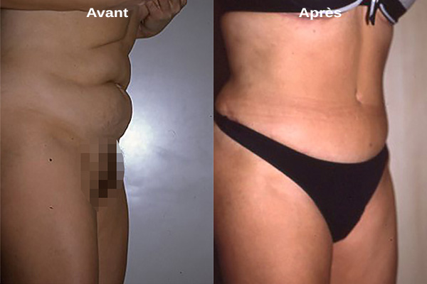 Liposuccion ou lifting du ventre : Quelle intervention choisir ?