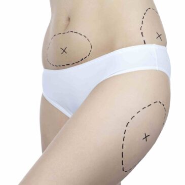 La liposuccion : Types et bienfaits