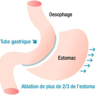 La sleeve pour perdre du poids rapidement