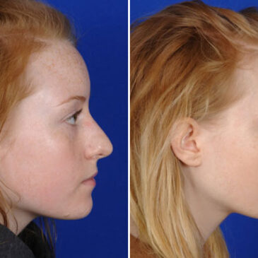 Les types d’une rhinoplastie : Chirurgie esthétique du nez