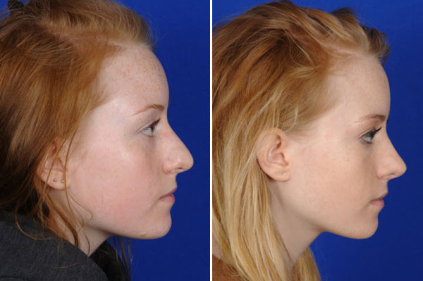 Les types d’une rhinoplastie : Chirurgie esthétique du nez