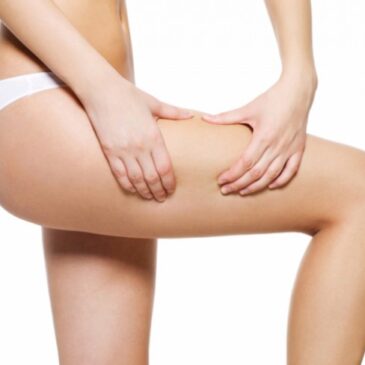 Traitement de la Cellulite par la liposuccion