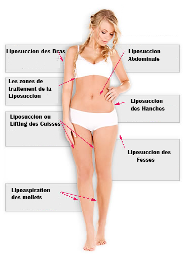 zones lipoaspiration 