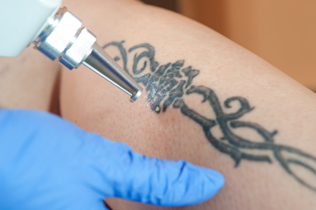 Enlever un tatouage avec le laser