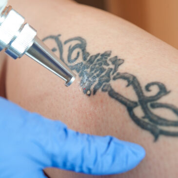 Enlever un tattoo avec le laser