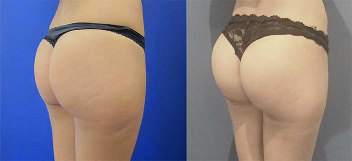 Augmentation des fesses par lipofilling