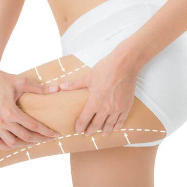 Qu’est ce qu’il faut savoir sur le lifting cuisses !