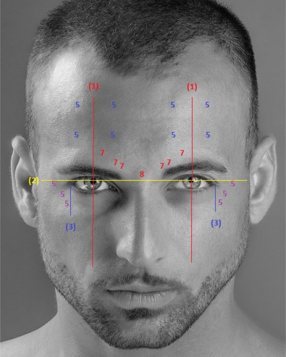 Des injections de toxine botulique pour homme : Est-ce efficace ?