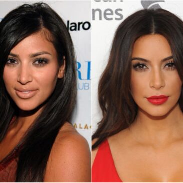 Chirurgie esthétique des stars : 30 photos avant et après