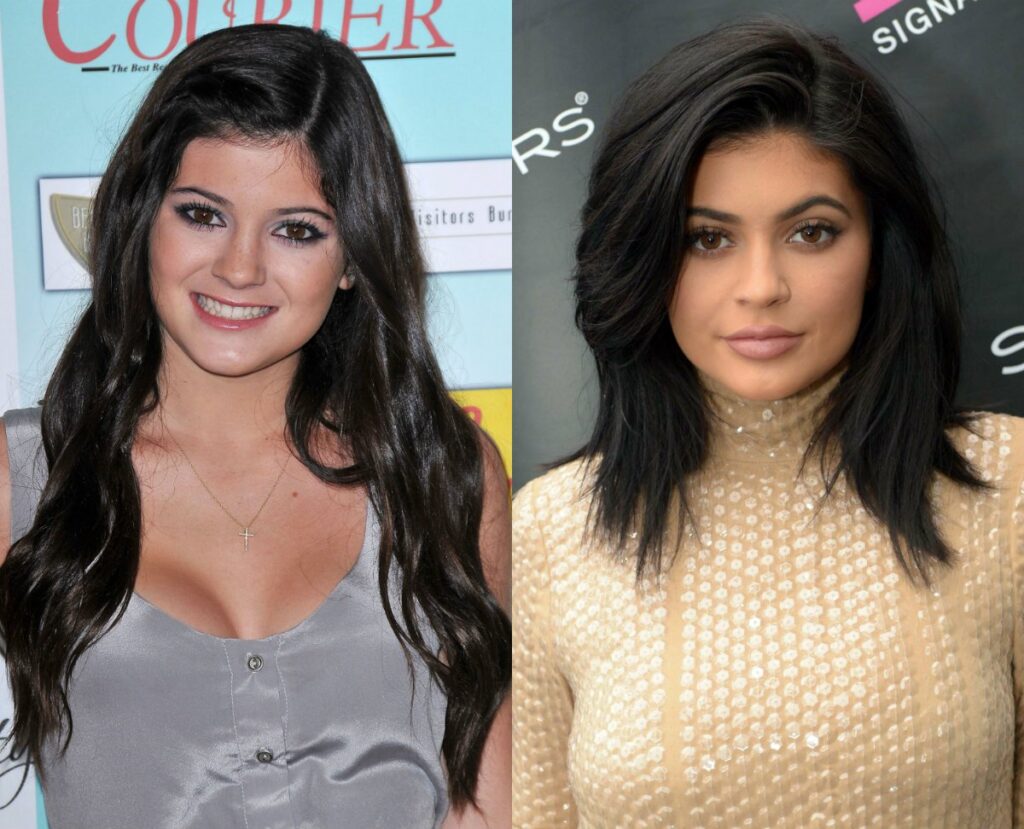 Kylie Jenner avant apres