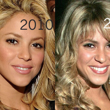 Shakira a-t-elle subi une opération de chirurgie plastique ?