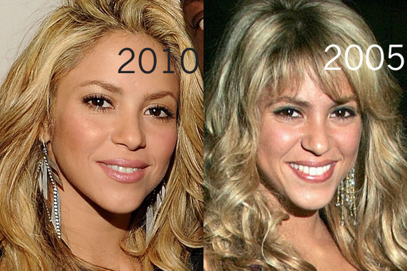 Shakira a-t-elle subi une opération de chirurgie plastique ?