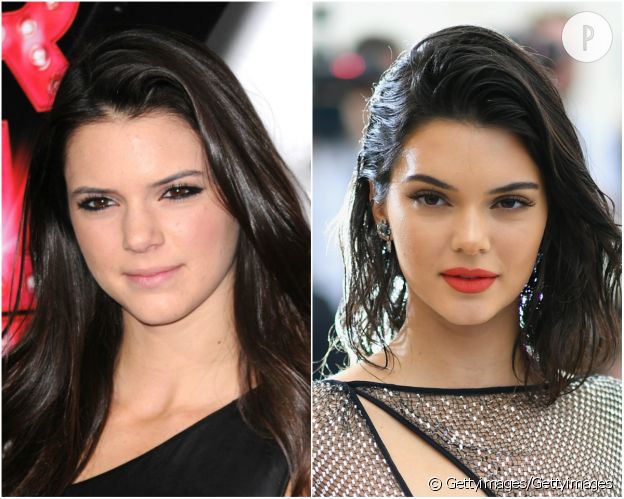 Kendall Jenner accro à la chirurgie esthétique ? Son visage nous dit la vérité !