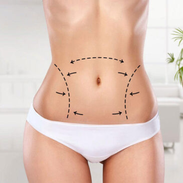 Liposuccion vaser, liposuccion douce ou liposuccion classique : quelle est la technique la plus efficace ?