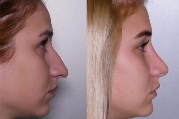 À partir de quand voit-on les résultats finaux de la rhinoplastie ?