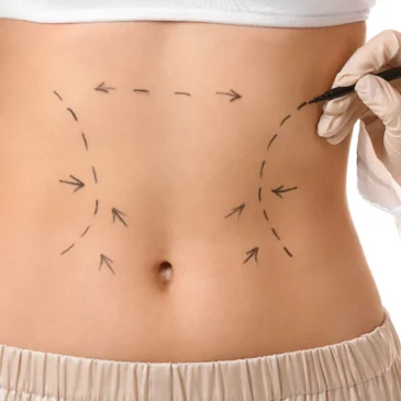 Pourquoi faire une liposuccion du ventre ?